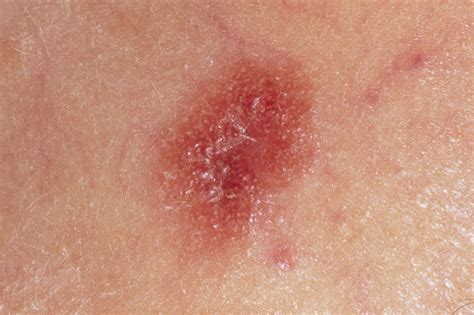 melanoma red spot on skin